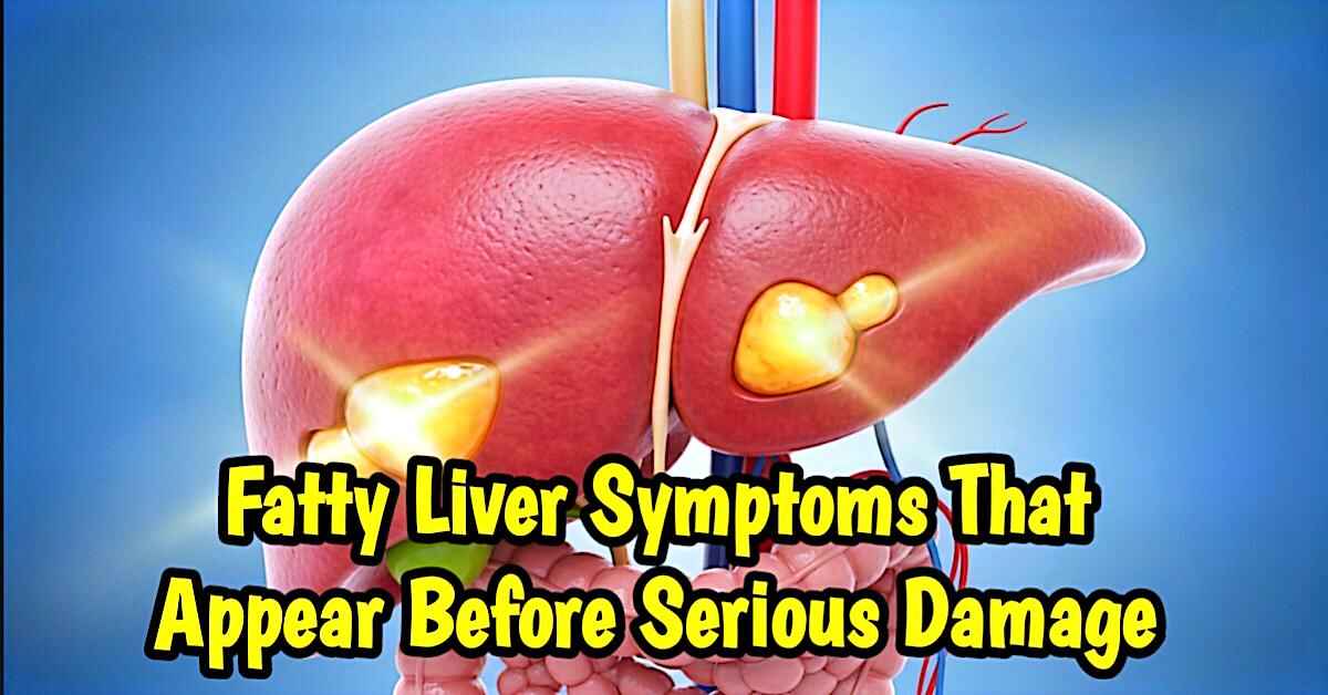 Fatty liver symptoms shown in detailed medical liver illustration